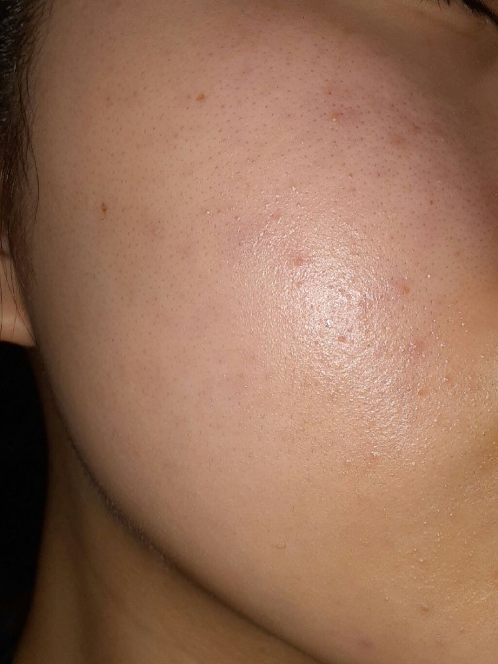 ペアアクネクリームW(医薬品)/ペア/その他を使ったクチコミ(4枚目)