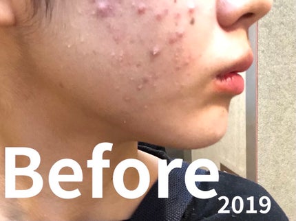 メラノフォーカスV/HAKU/美容液を使ったクチコミ(1枚目)