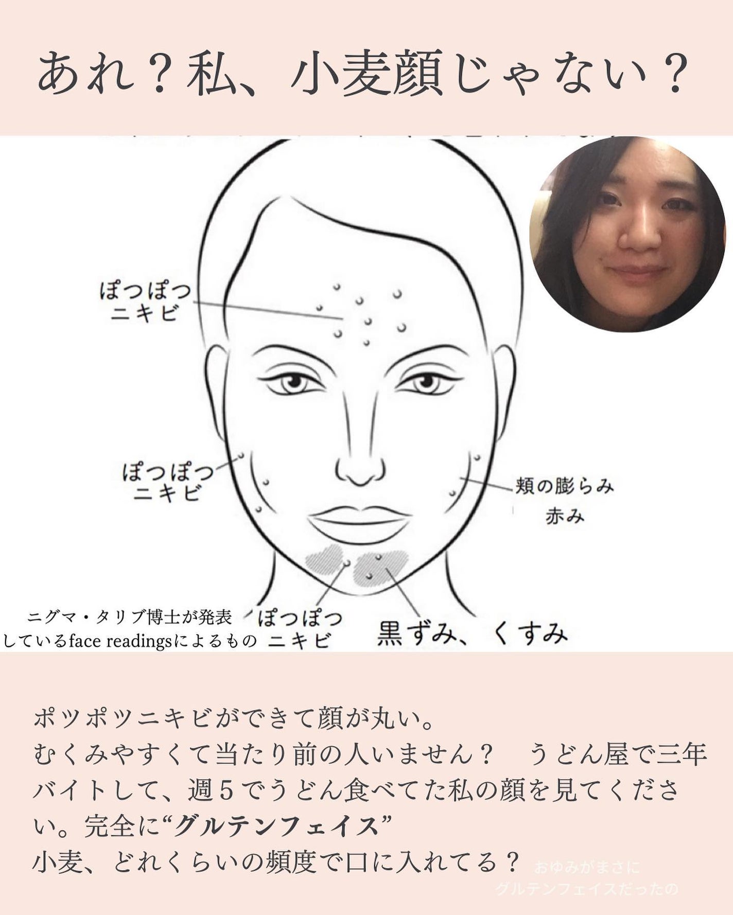 おゆみ|ニキビ・ニキビ跡ケア on LIPS 「「小麦、まだ食べてる?」小麦が肌荒らすってまだ知らないなら死ぬ..」(3枚目)