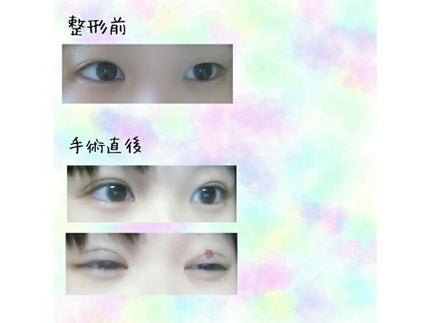 二重整形/その他を使ったクチコミ(2枚目)