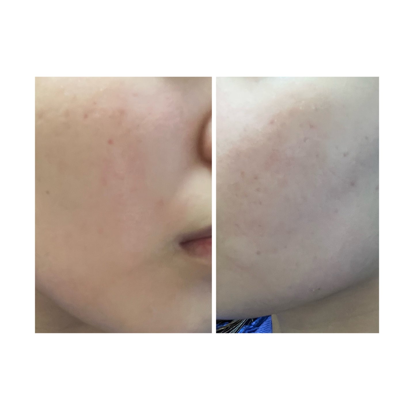 ぽむ on LIPS 「2023.9.13皮膚科に受診 エピデュオとヘパリン処方1枚目..」(1枚目)