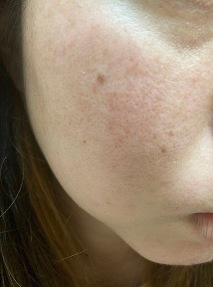 しい on LIPS 「カソーダ17日目皮むけ再び始まりました♡頬の皮が剥けてシミが薄..」(2枚目)