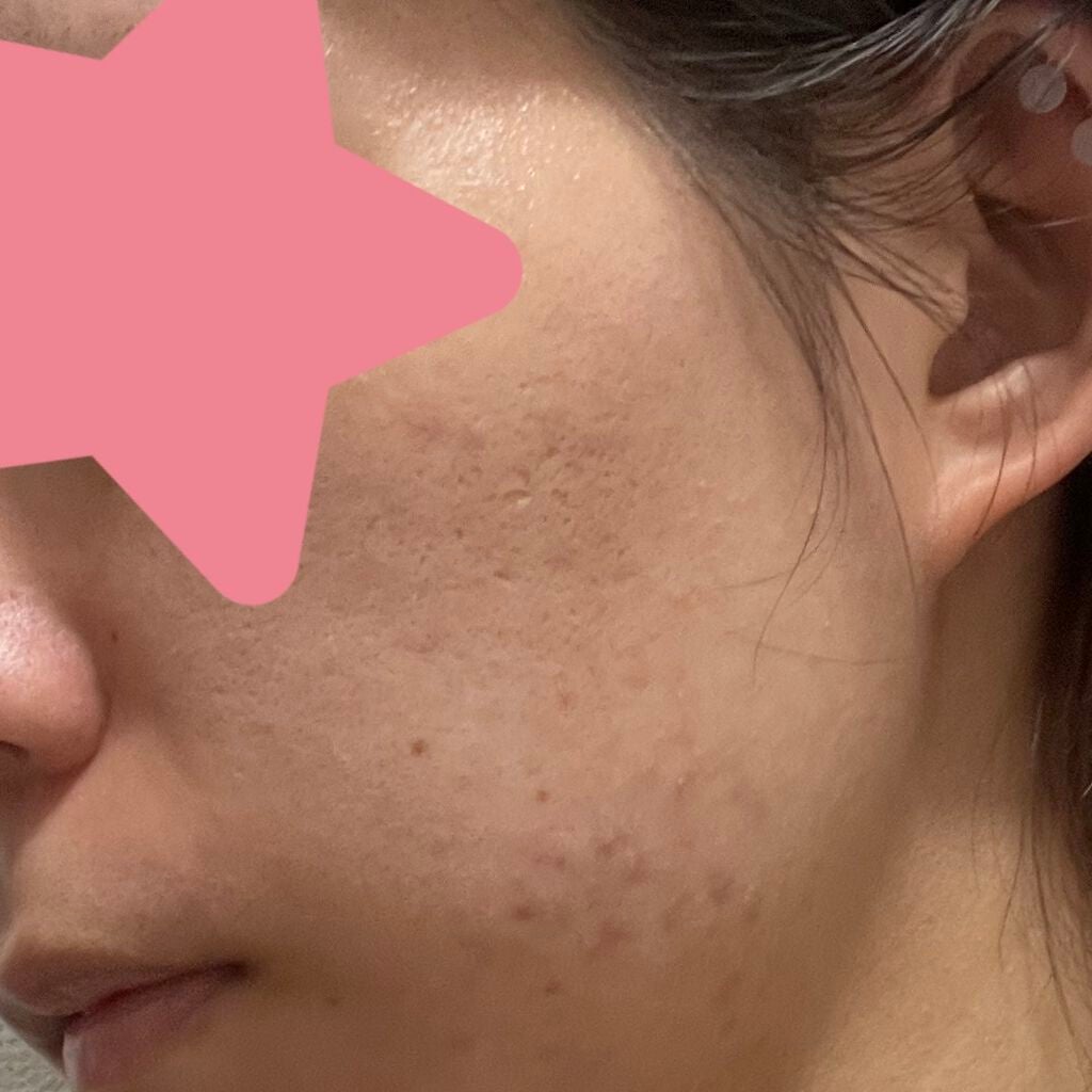 アポスティークリーム(医薬品)/アポスティー/その他を使ったクチコミ(2枚目)