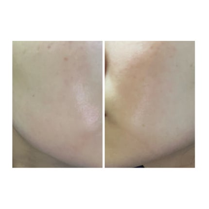 ぽむ on LIPS 「2023.9.13皮膚科に受診 エピデュオとヘパリン処方1枚目..」(5枚目)