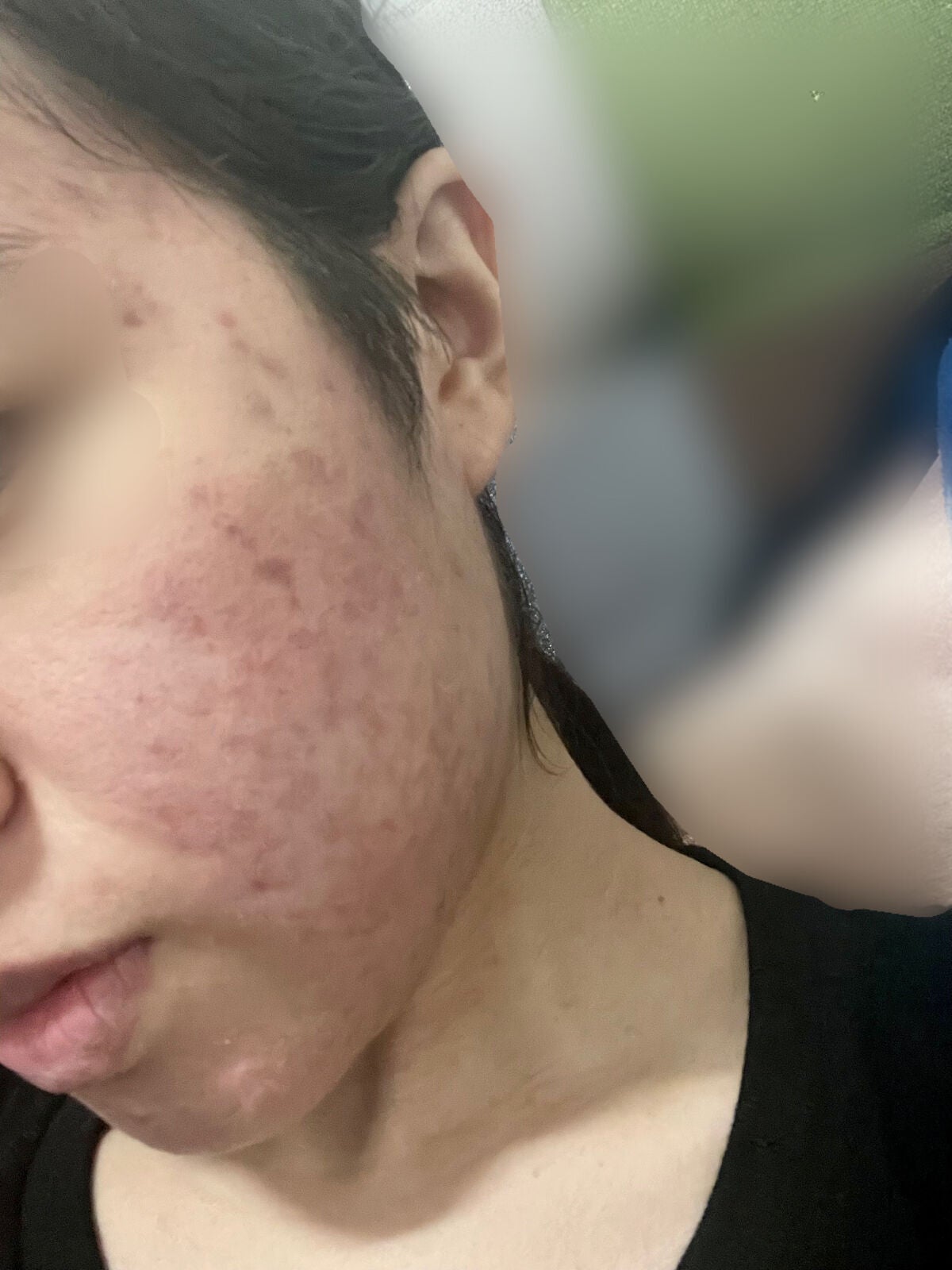 なぁな on LIPS 「お久しぶりです!皮膚科の薬を使用してから約2ヶ月が経ちます。以..」(2枚目)