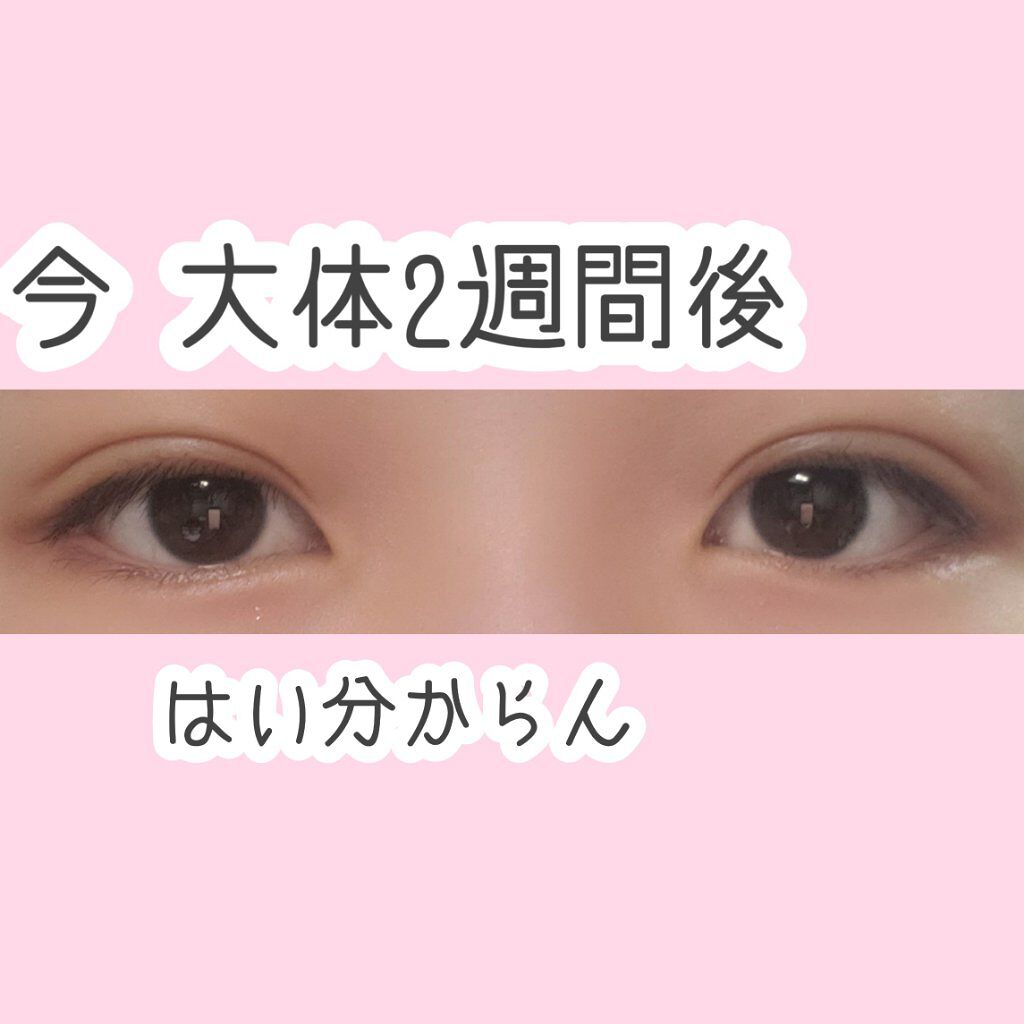 太郎 on LIPS 「お久しぶりです❢太郎と申します❢この度私太郎は念願の埋没をして..」(5枚目)