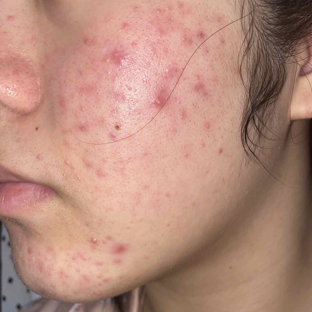 ぴろ on LIPS 「ニキビ撲滅日記を5/25~始めました🔥25日に始めようとしたん..」(3枚目)