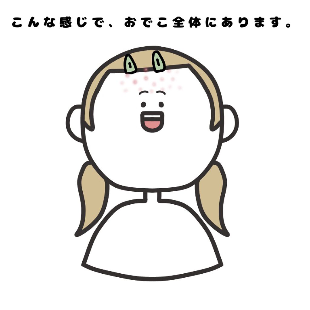オロナインH軟膏 (医薬品)/オロナイン/その他を使ったクチコミ(2枚目)