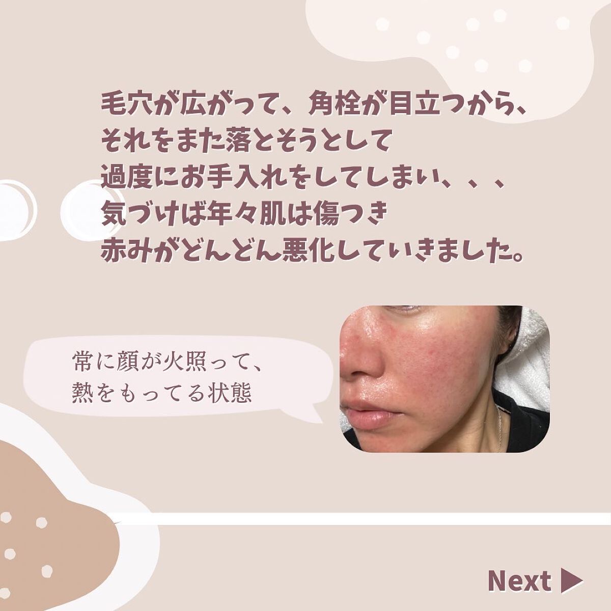 まゆめ on LIPS 「\🌟敏感肌がコンプレックスから脱却するまでにやったこと🌟/長年..」(4枚目)