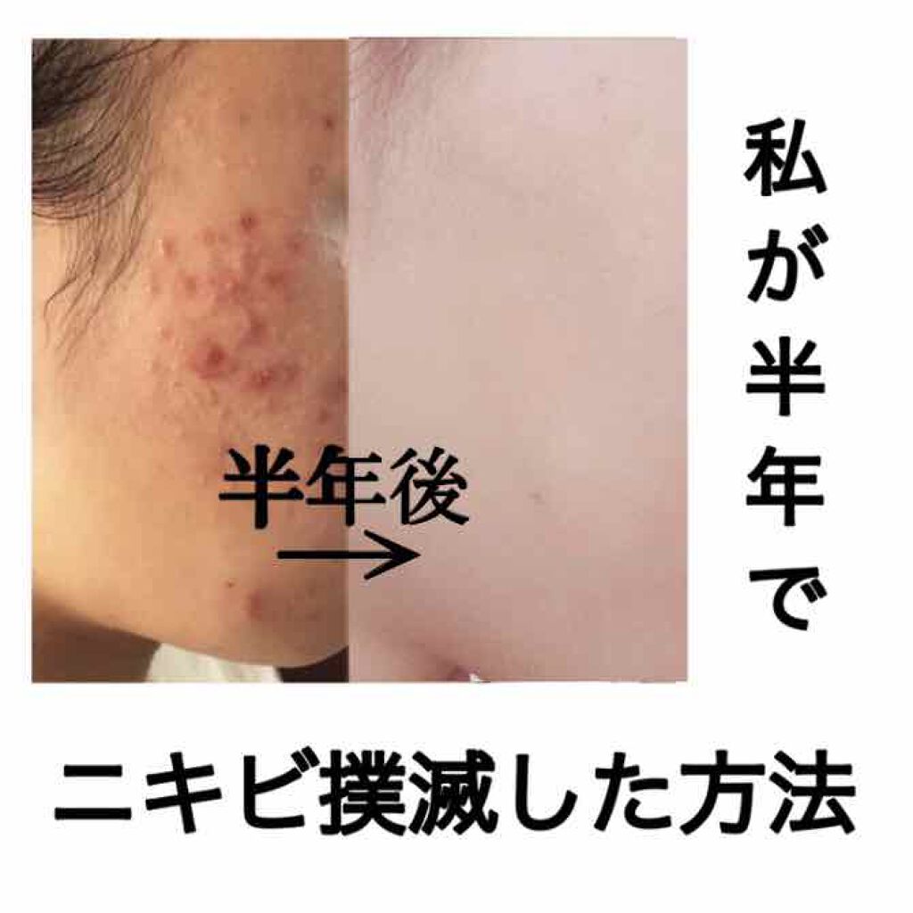 クラブ すっぴんパウダー クラブを使った口コミ お久しぶりです 投稿が遅くなってしまい申し By さよならニキビちゃん 混合肌 10代後半 Lips クラブ すっぴんパウダー クラブを使った口コミ お久しぶりです 投稿が遅くなってしまい申し By さよならニキビちゃん 混合肌 10代後半 Lips