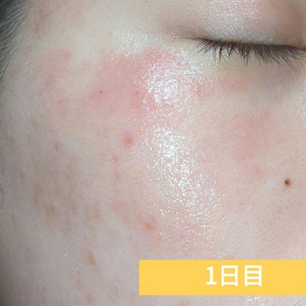 カユピット(医薬品)/メンソレータム/その他を使ったクチコミ(2枚目)