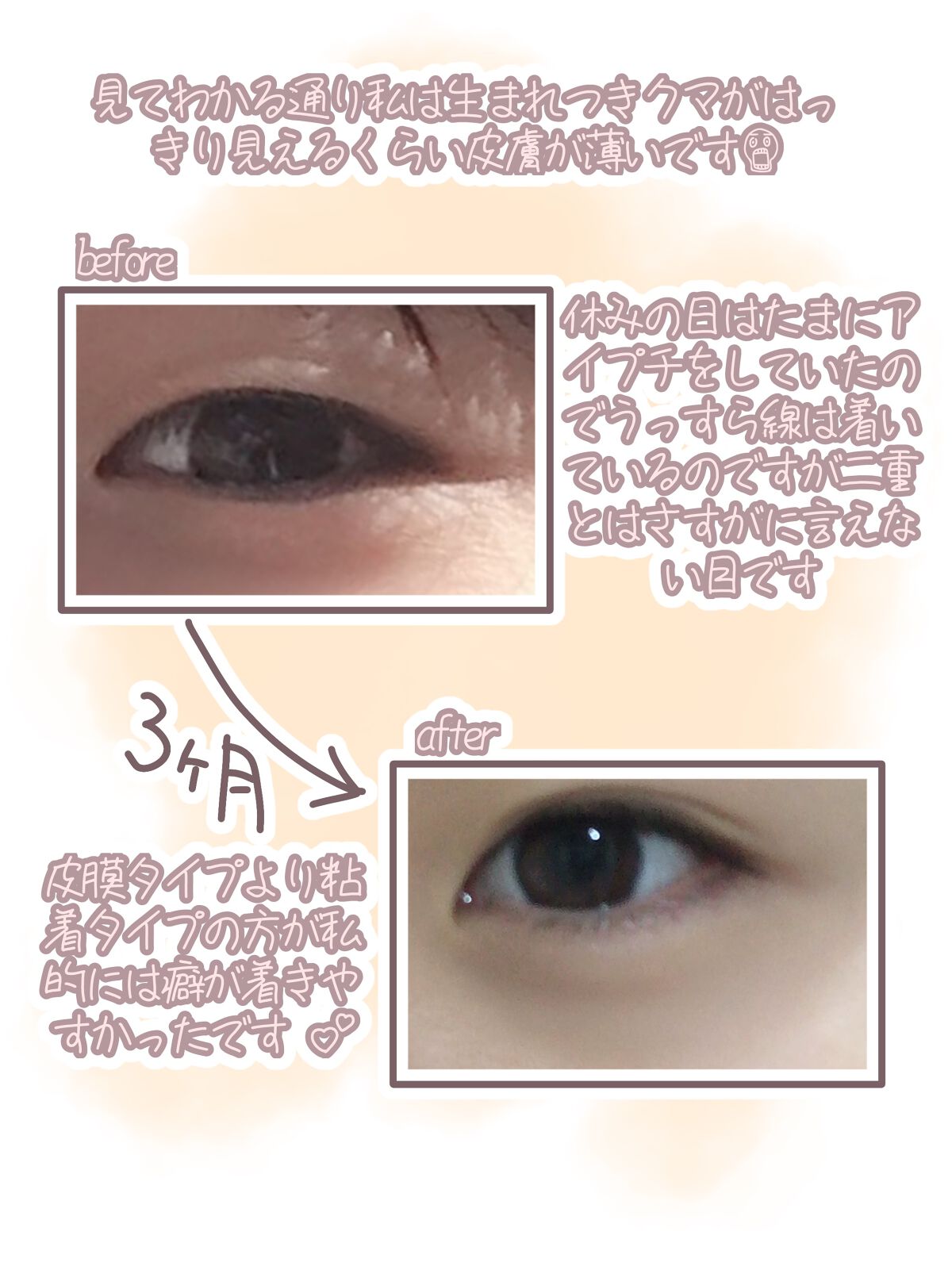 アイトーク/アイトーク/二重まぶた用アイテムを使ったクチコミ(2枚目)