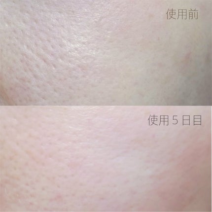 マイルドリードルショット50/VT/美容液を使ったクチコミ(8枚目)