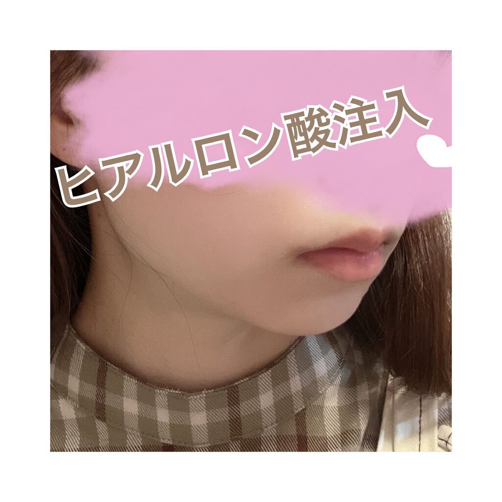 ヒアルロン酸注入/プラウドクリニック/その他を使ったクチコミ(1枚目)