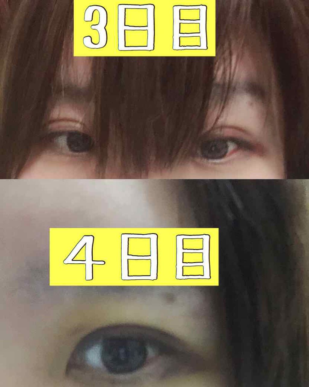 綺 on LIPS 「※2枚目以降ダウンタイムの写真があります。ご注意ください。二重..」(3枚目)