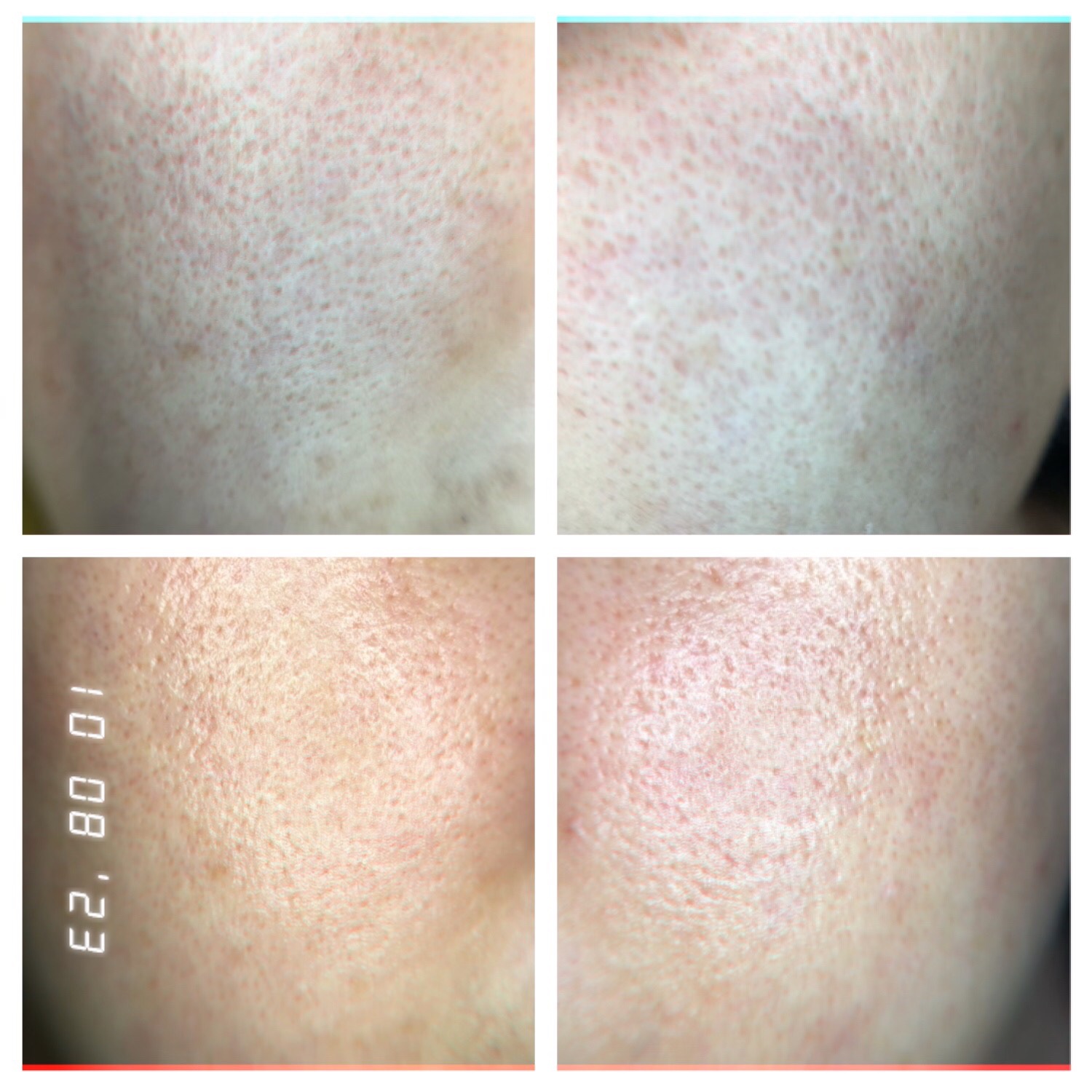 AGE-Rダーマエアショット/MEDICUBE/美顔器・マッサージを使ったクチコミ（2枚目）