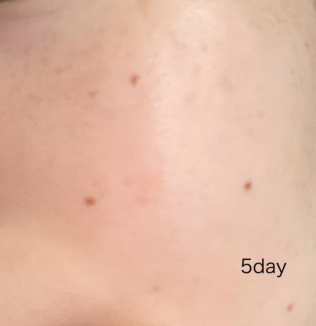 TXトーニングエッセンス1000SHOT/VT/美容液を使ったクチコミ（3枚目）