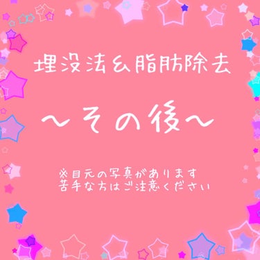 自分用のメモとして記録するので、文章が分かりずらかったり、読みにくかったりするかも知れませんが、誰かの参考になれば幸いです！

埋没法＆脂肪除去してから、約1年3か月ほど経ちました。

私はもともと脂肪