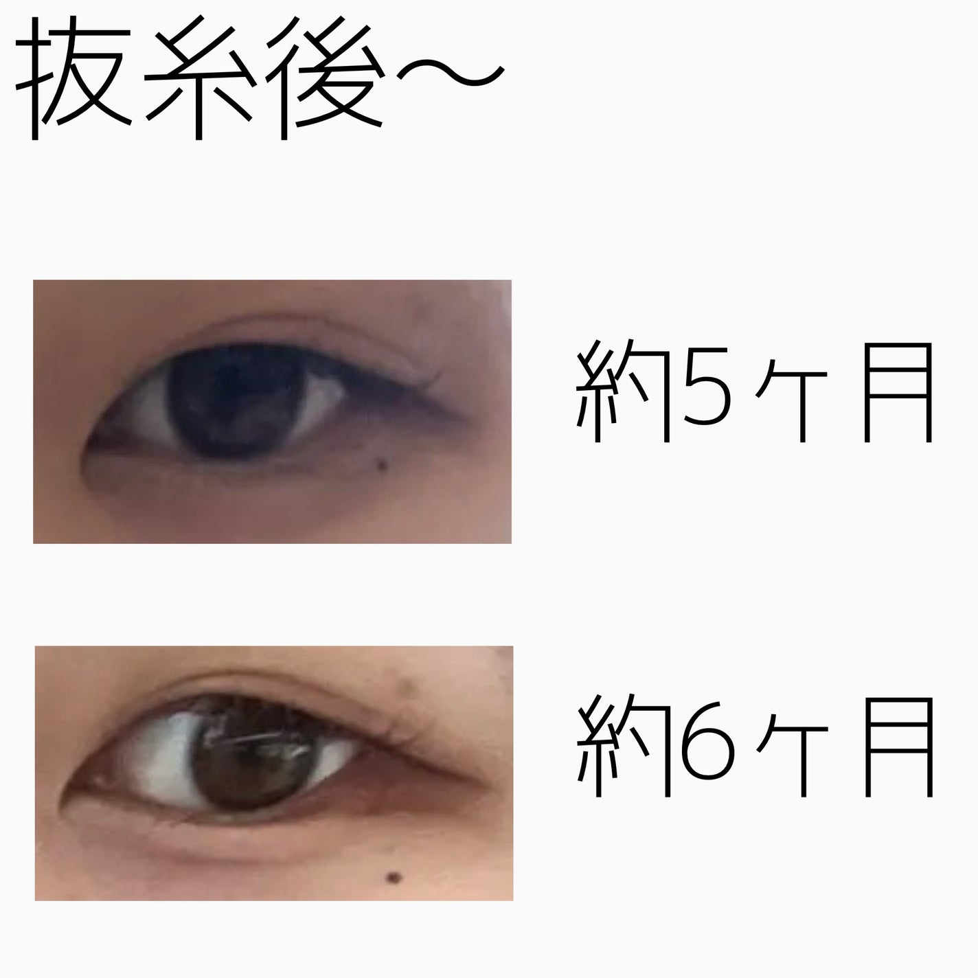 NANO@フォロバ! on LIPS 「二重整形ダウンタイム記録/抜糸してから半年が経ちました。約1ヶ..」(4枚目)