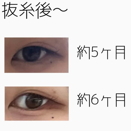 NANO@フォロバ! on LIPS 「二重整形ダウンタイム記録/抜糸してから半年が経ちました。約1ヶ..」(4枚目)