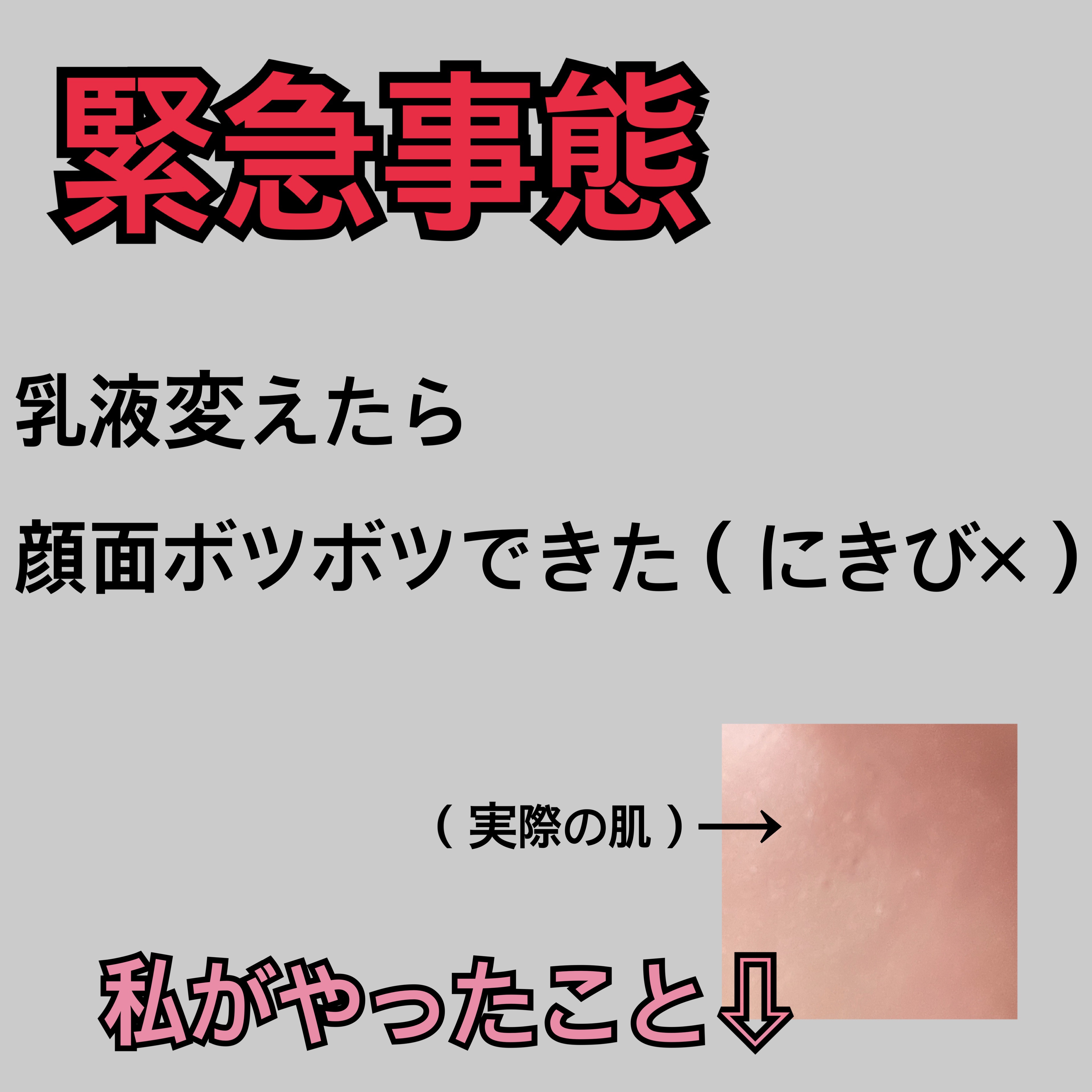 リンデロンVs軟膏（医薬品）/シオノギ製薬/その他を使ったクチコミ（1枚目）