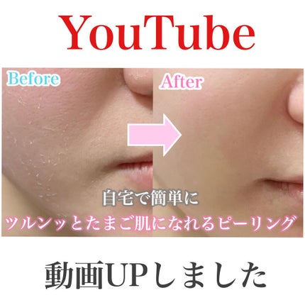 ごんす@YouTube始めました on LIPS 「《YouTube動画UPしました》【ハーブピーリング】一週間で..」(1枚目)