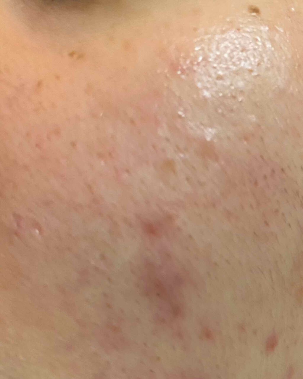 ACC パッチ/ETUDE/シートマスク・パックを使ったクチコミ(3枚目)