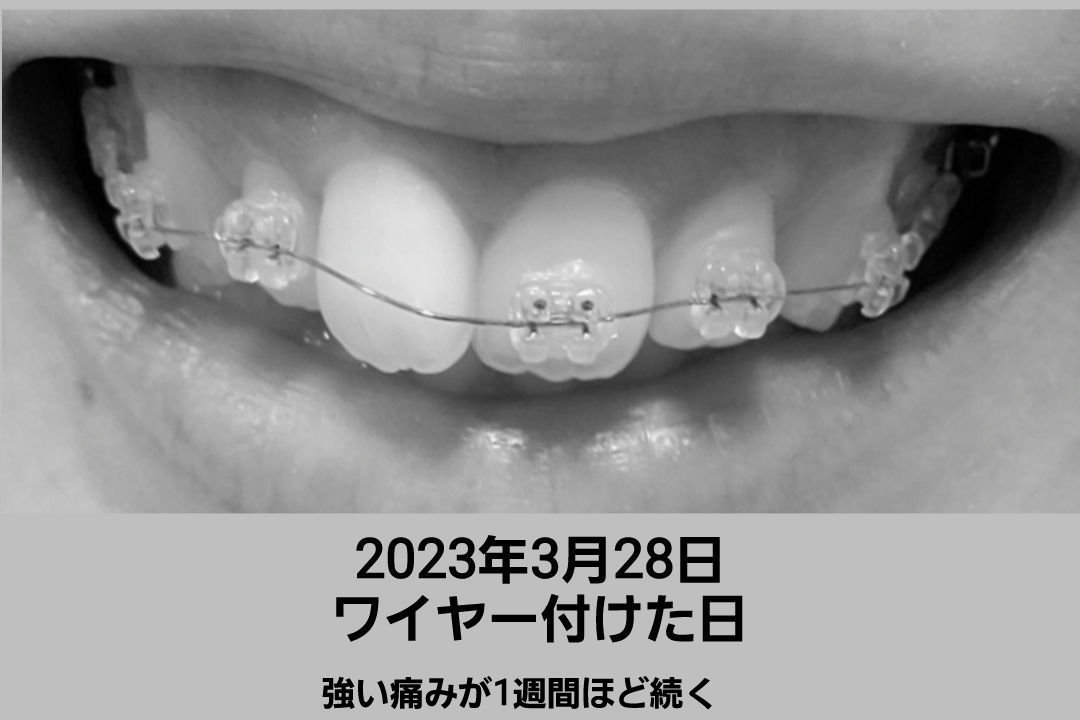 デンタルラボ　マウスピース・矯正用リテーナー用洗浄剤/アース製薬/その他オーラルケアを使ったクチコミ（2枚目）