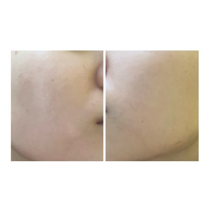 ぽむ on LIPS 「2023.9.13皮膚科に受診 エピデュオとヘパリン処方1枚目..」(2枚目)