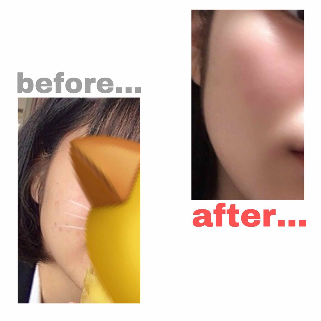 A アクネフォーム Novを使った口コミ ニキビだらけの汚肌を美肌にするまでの過程 By ぴぃこ 乾燥肌 Lips A アクネフォーム Novを使った口コミ ニキビだらけの汚肌を美肌にするまでの過程 By ぴぃこ 乾燥肌 Lips