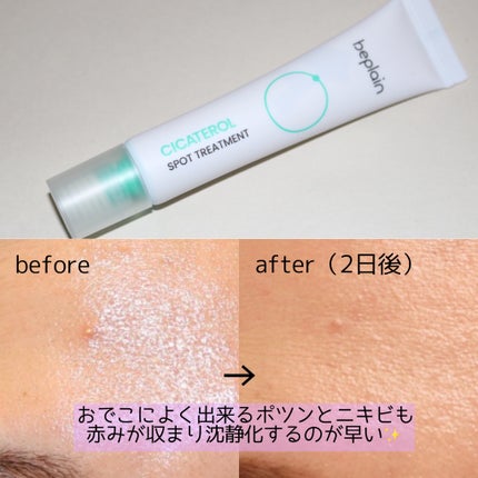 シカテロル スポットトリートメント/beplain/フェイスクリームを使ったクチコミ(5枚目)