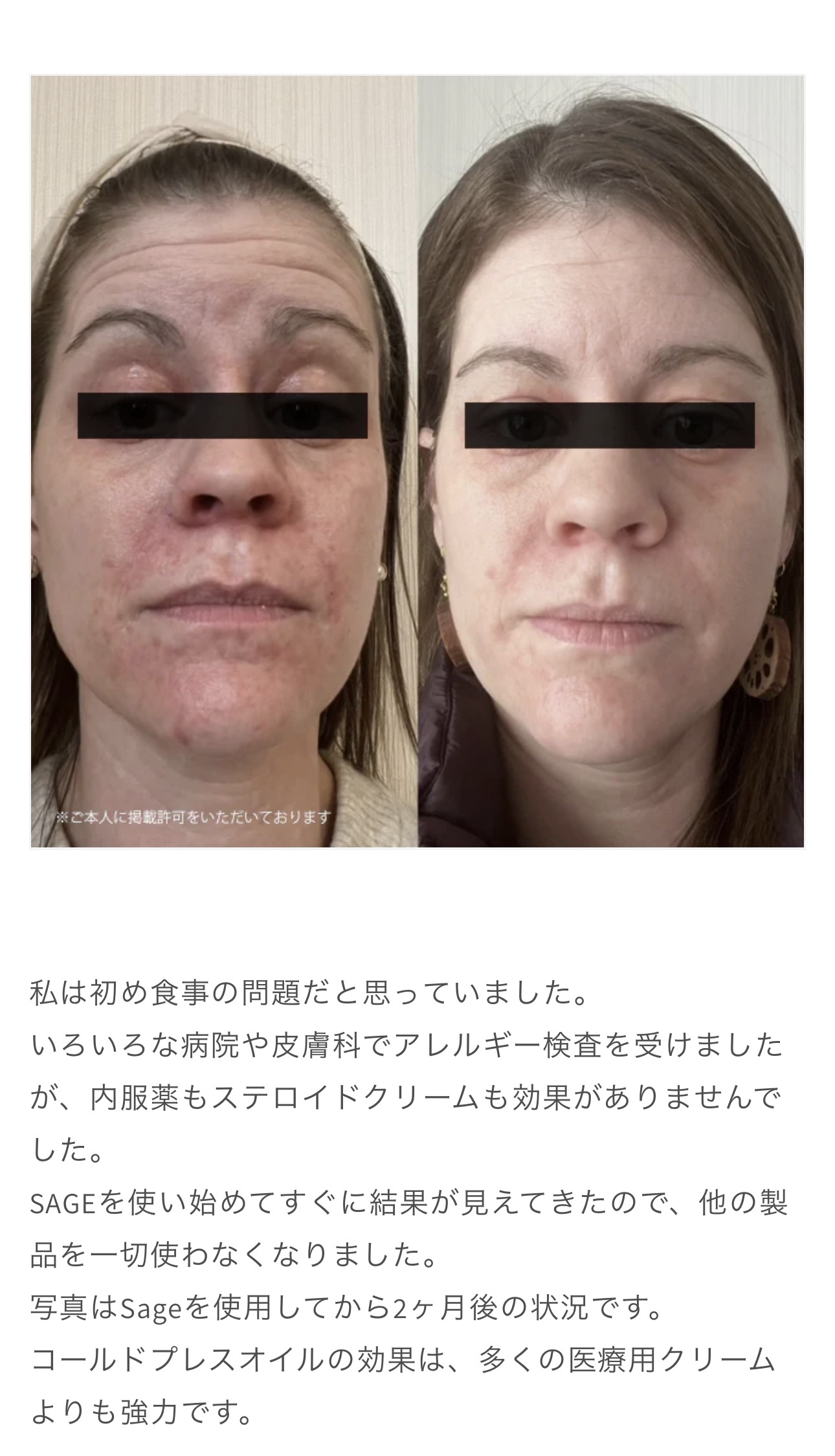 Sage Beauty Oil 皮膚科ビフォーアフター :
Sage ビューティーブレンドはオメガ6＆9とポリフェノールを含むファイトケミカルが豊富に含まれ、強力な抗酸化作用があります。一年中輝く健康的な肌のための、完璧な抗酸化ブースターで