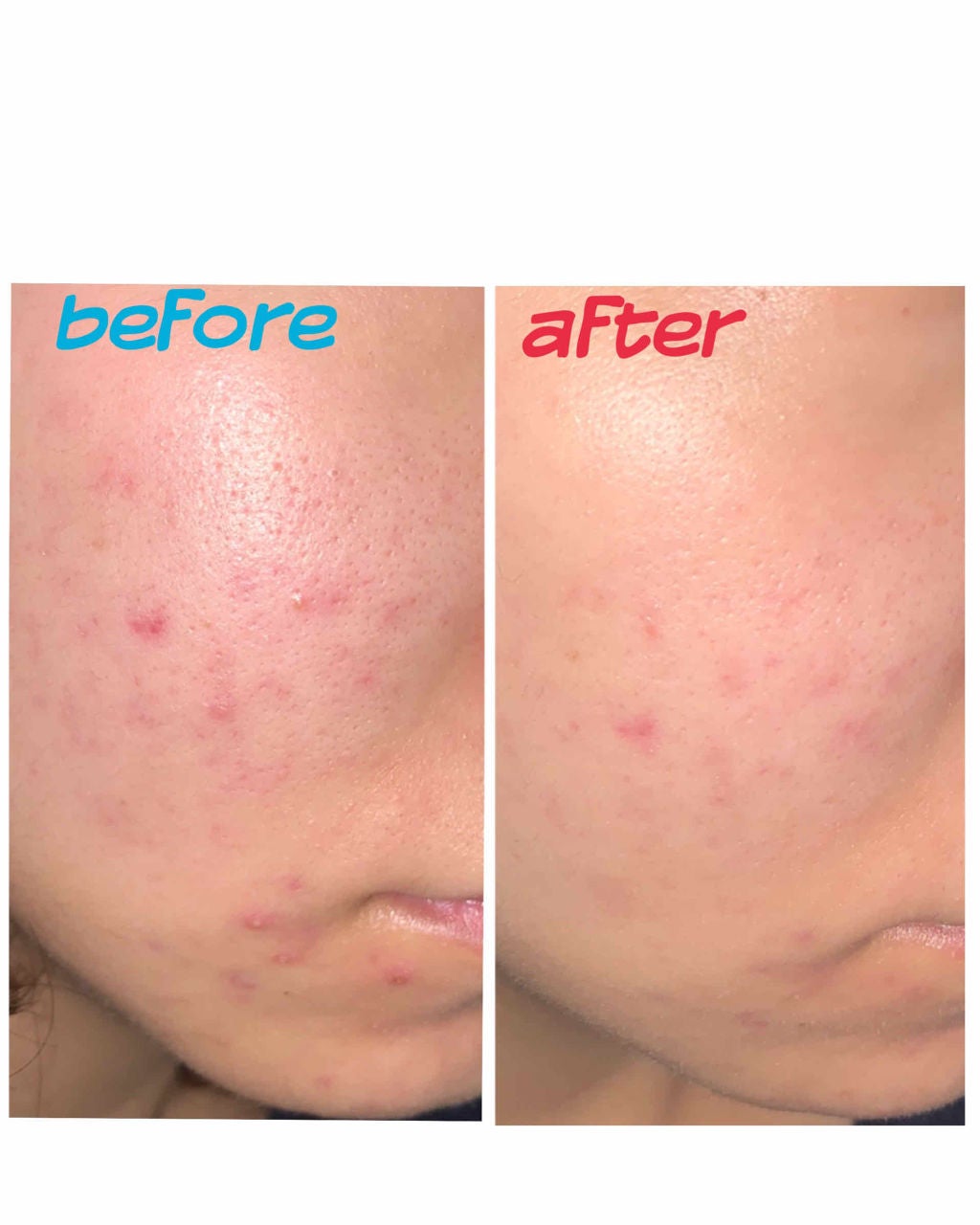 チョコラBBプラス (医薬品)/チョコラBB/その他を使ったクチコミ(2枚目)