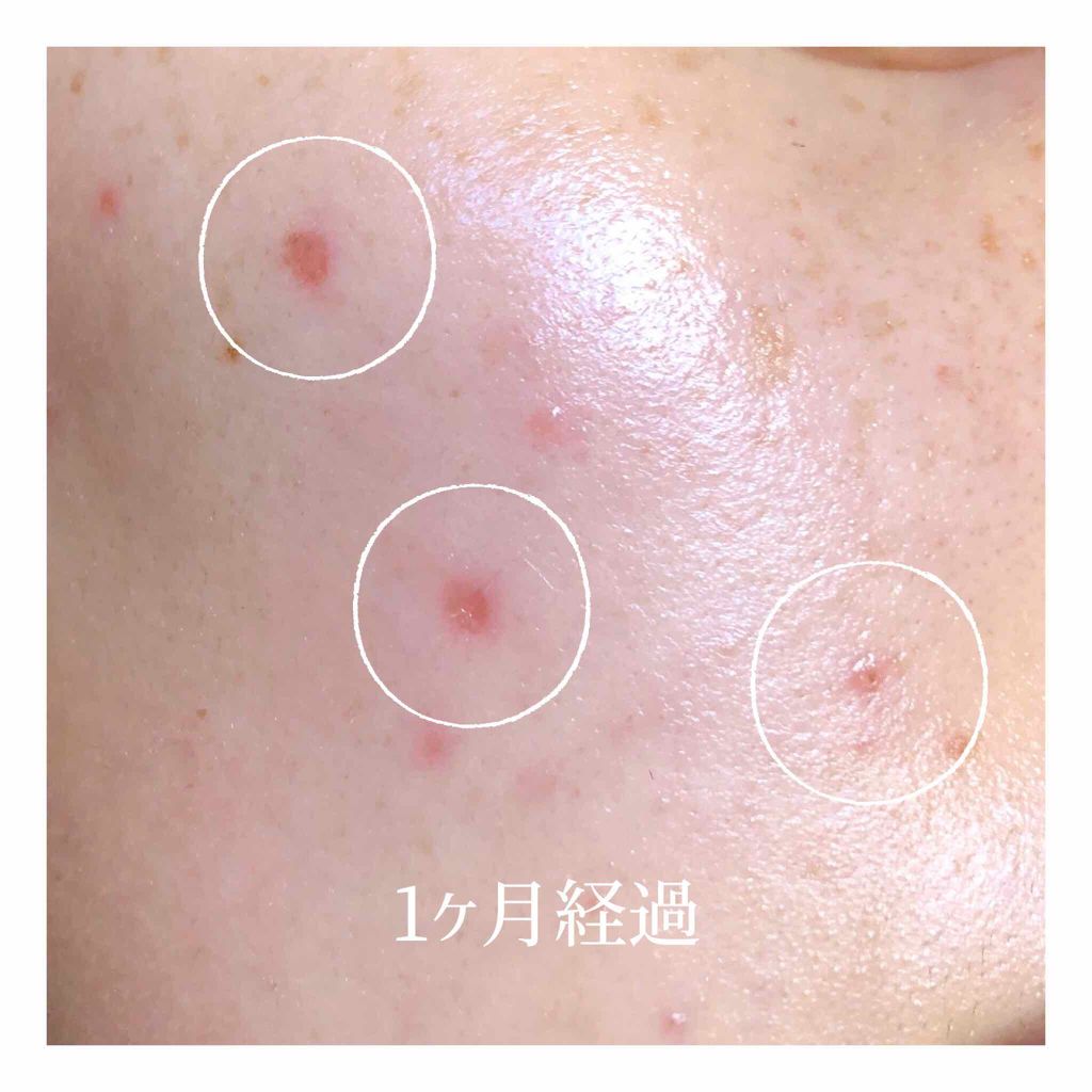 テラ・コートリル 軟膏(医薬品)/ジョンソン・エンド・ジョンソン/その他を使ったクチコミ(2枚目)