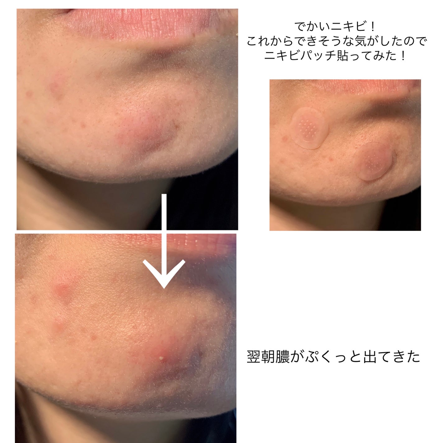 パンテノールシカブレミッシュニードルパッチ/BIOHEAL BOH/にきびパッチを使ったクチコミ(5枚目)