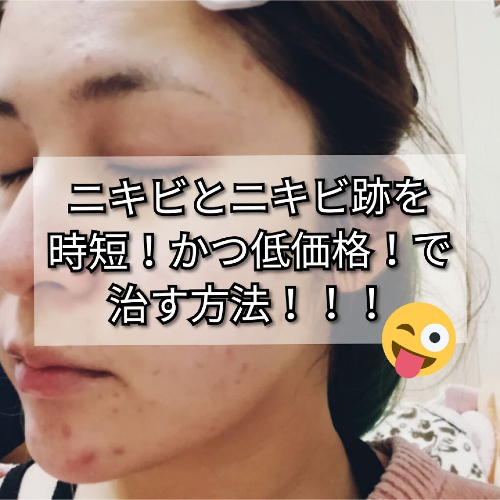 ビーソフテン ローション(医薬品)/持田製薬/その他を使ったクチコミ（1枚目）