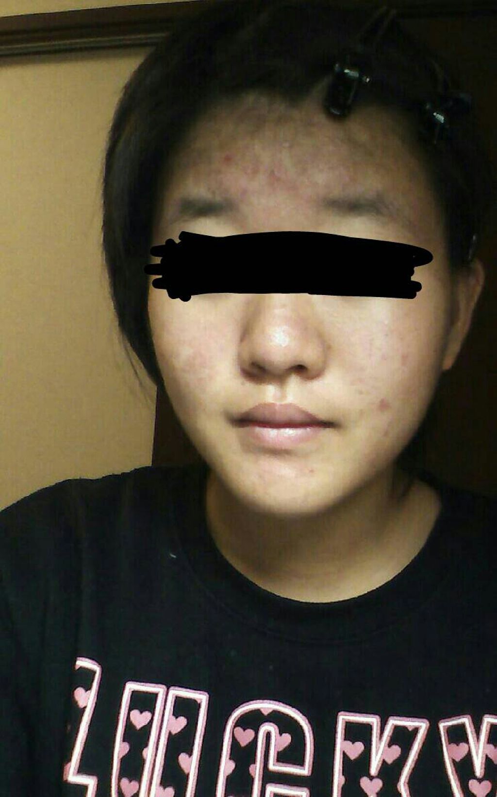 テラ・コートリル 軟膏(医薬品)/ジョンソン・エンド・ジョンソン/その他を使ったクチコミ（1枚目）