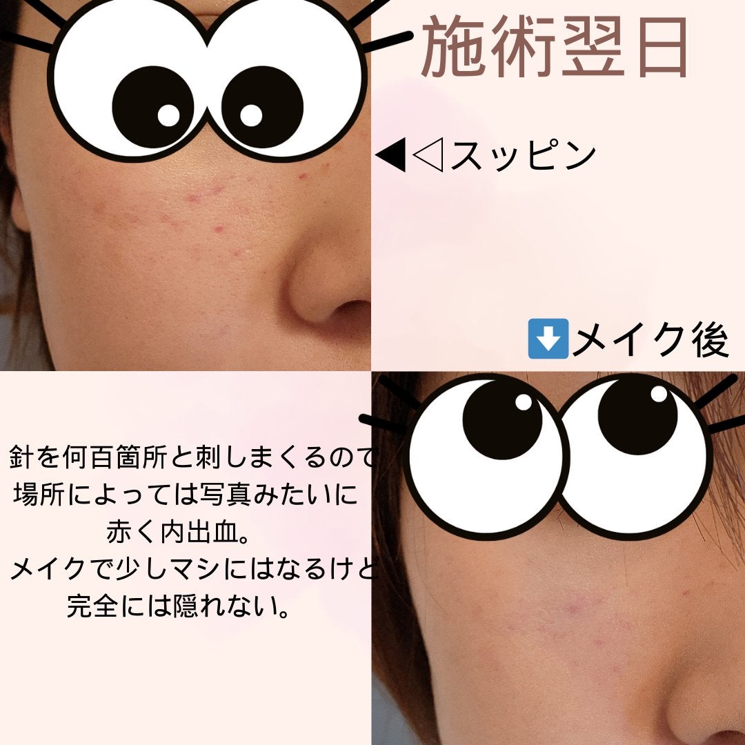 Lim(コスメコンシェルジュ) on LIPS 「初の美容医療!オラクル美容皮膚科にて、リジェバンピュアのモニタ..」(4枚目)