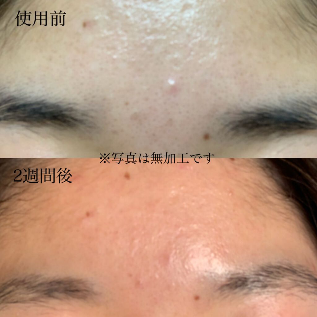 セラムショット N/PHOEBE BEAUTY UP/美容液を使ったクチコミ(3枚目)