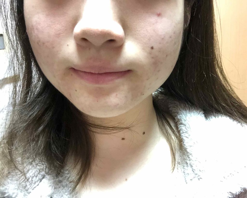 マンスリースキンケアプログラム(旧)/APEX/スキンケアキットを使ったクチコミ（2枚目）