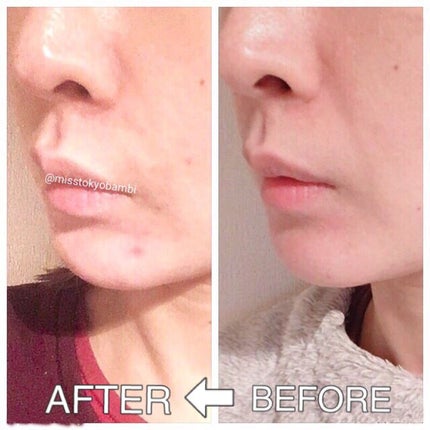 白ゆり@美容ブロガー on LIPS 「プラウドクリニックでほうれい線にヒアルロン酸注入してきたレポ✍..」(4枚目)