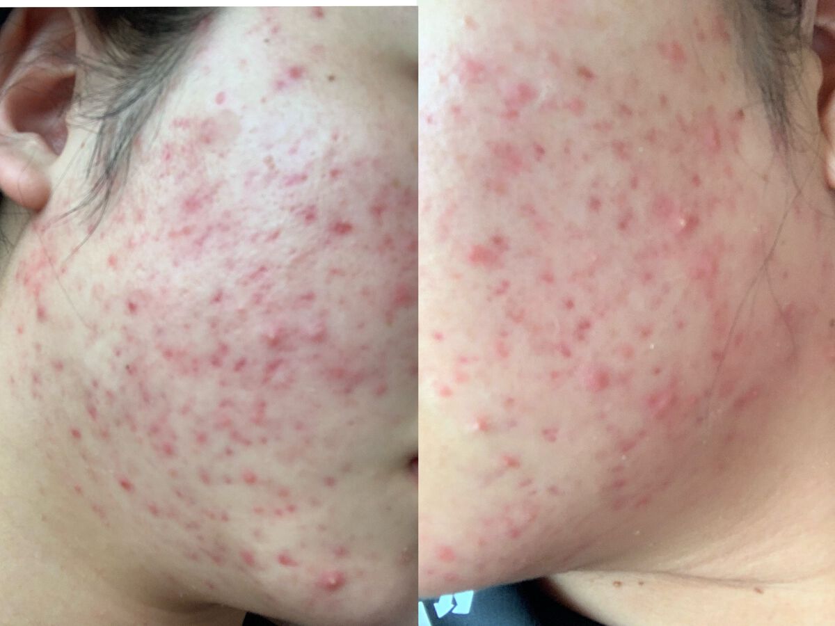 薬用 クリアローション L(さっぱりタイプ)/オルビス/化粧水を使ったクチコミ(1枚目)