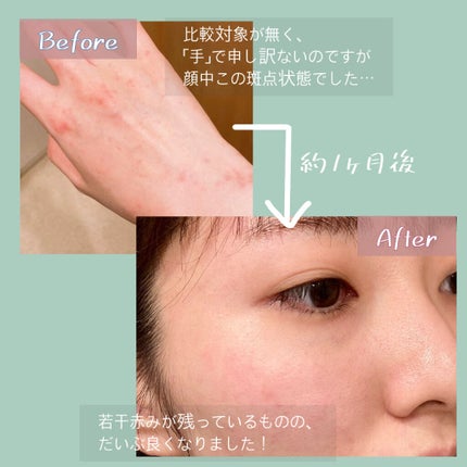 ミノン アミノモイスト 薬用アクネケア ローション/ミノン/化粧水を使ったクチコミ(4枚目)