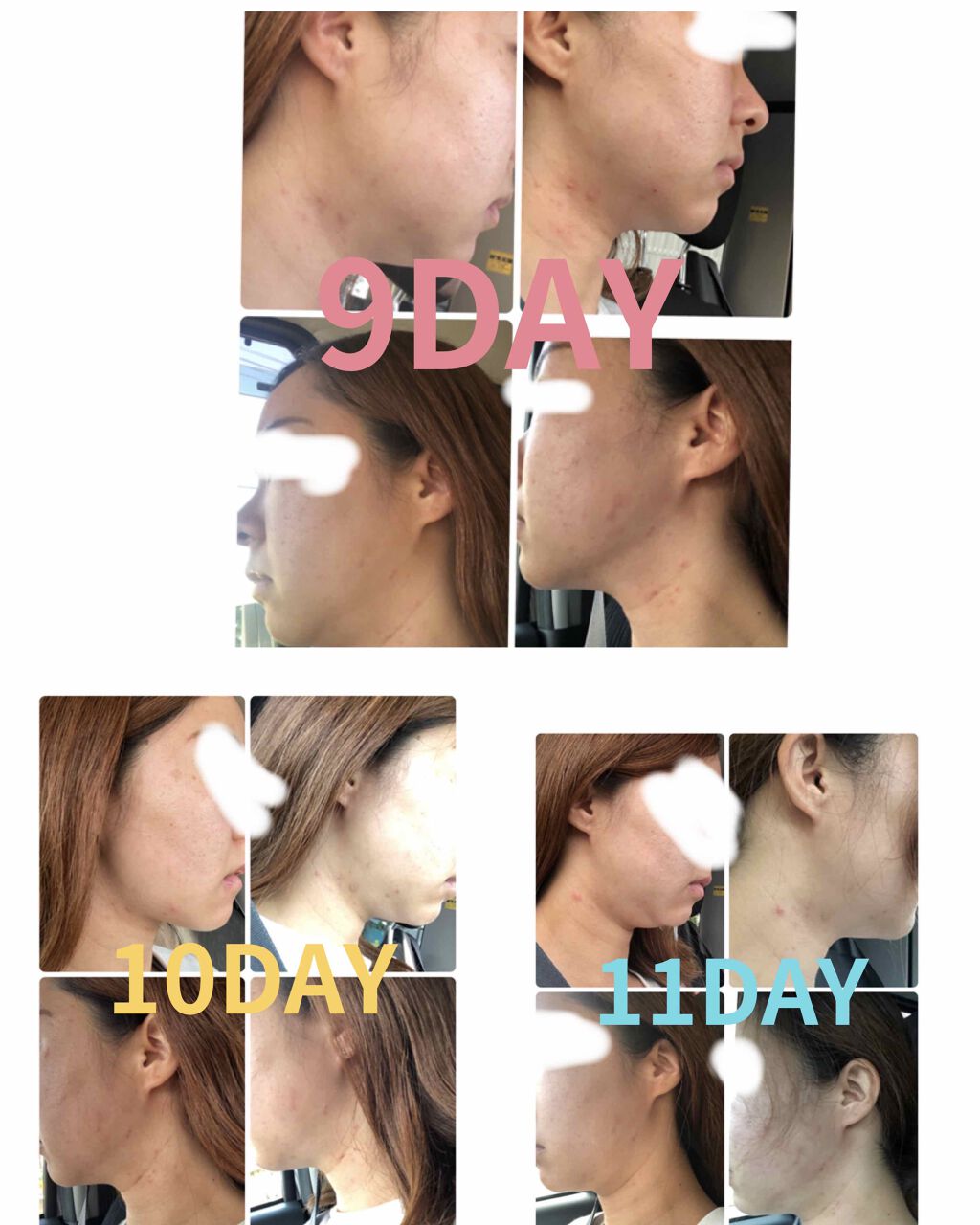 ペアアクネクリームW(医薬品)/ペア/その他を使ったクチコミ（3枚目）