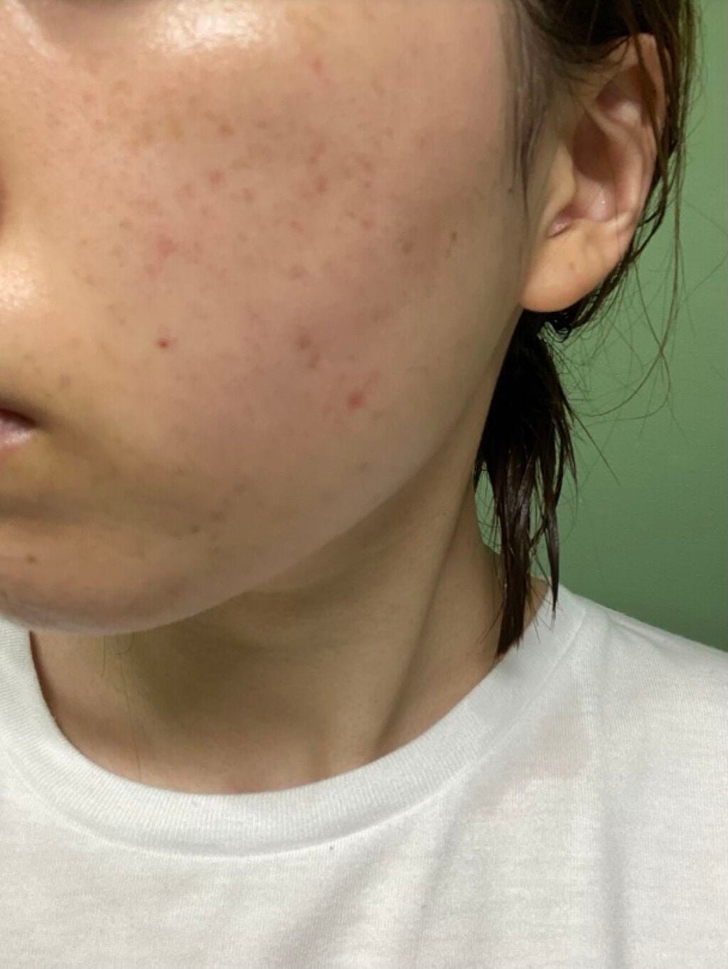 薬用アクネホワイトニング ジェル(部分用美容液)/DHC/美容液を使ったクチコミ(3枚目)