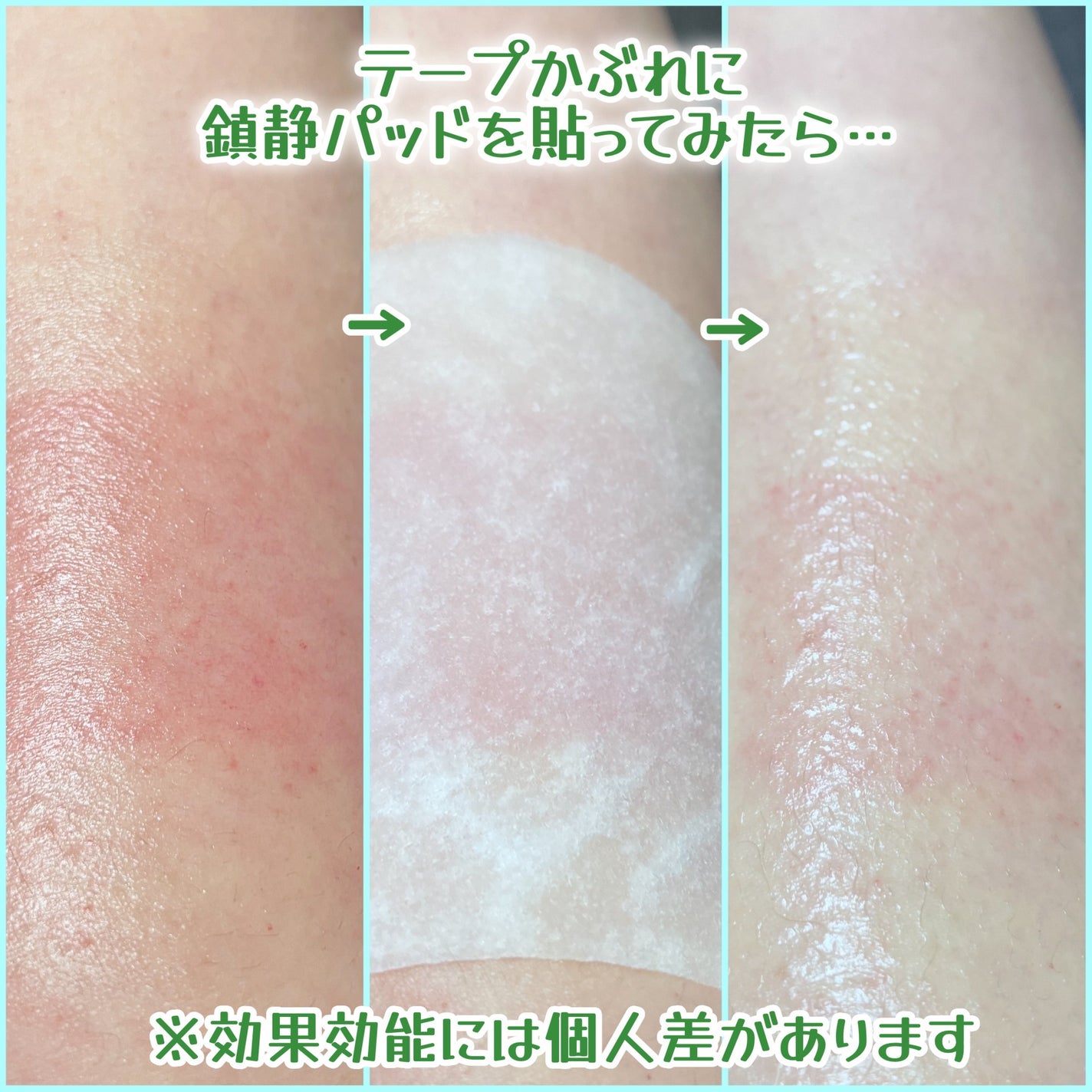 ドクダミテンダーゾームダブルカーミング水分アンプル/ilso/美容液を使ったクチコミ(9枚目)