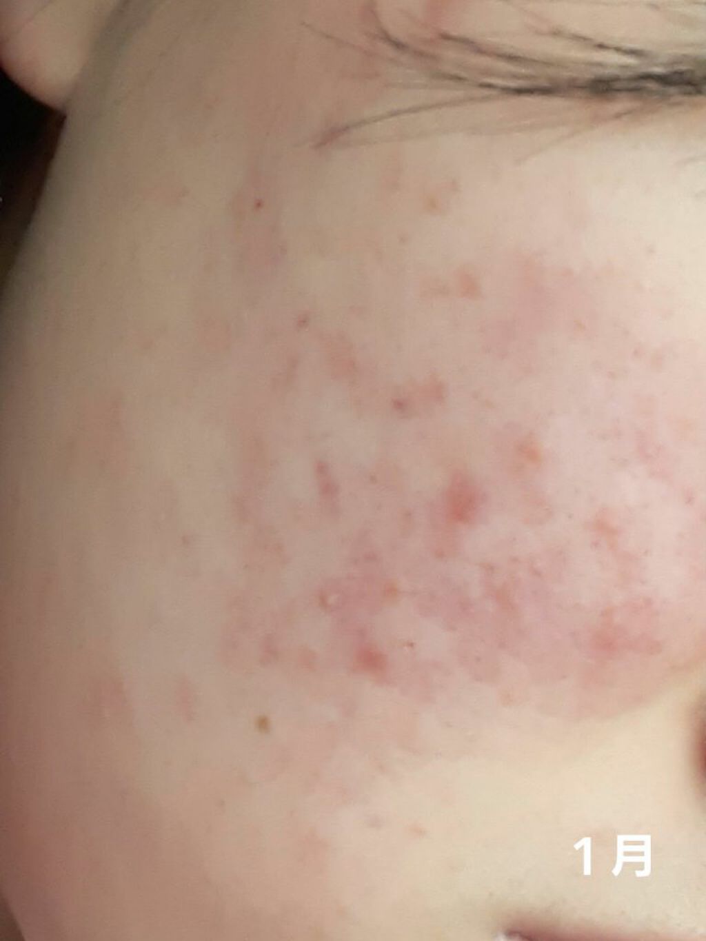 トラブルリペア リキッド/アルージェ/美容液を使ったクチコミ（3枚目）