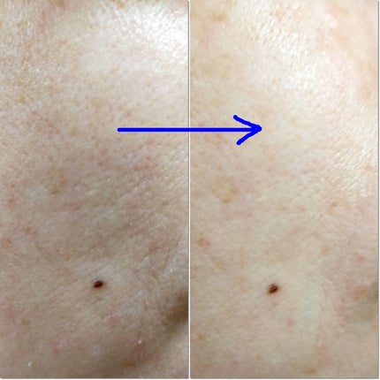 ゼロ1DAYエクソソームショット2000/MEDICUBE/美容液を使ったクチコミ(4枚目)