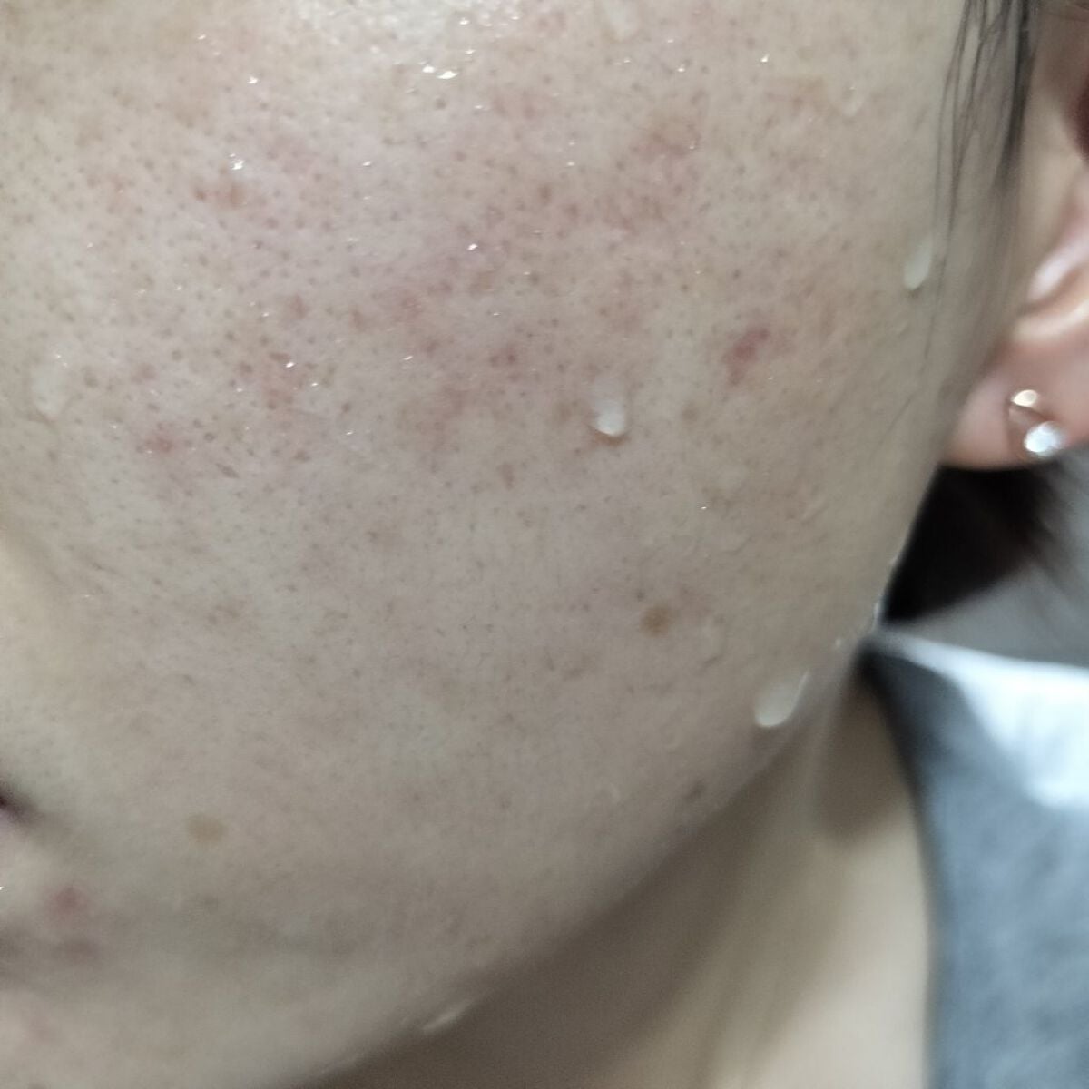 miina@汚肌工事録⚠️ on LIPS 「10/21の#汚肌工事録ん?この日は割とマシ。でも日本にいたと..」(2枚目)