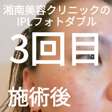 IPLフォトダブル/湘南美容/その他を使ったクチコミ（1枚目）